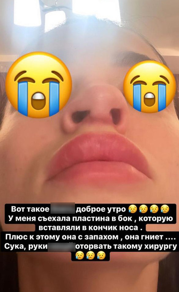 У звезды «ДОМа-2» Анастасии Балинской провалился и гниет нос
