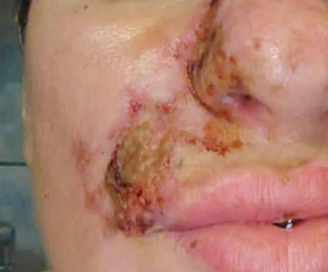 «Рубец на лице»: Женщина в Чите пострадала от рук неквалифицированного косметолога