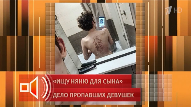 Гематомы на спине — следы от избиения широким ремнем | Источник: Из эфира «Пусть говорят» / Первый канал