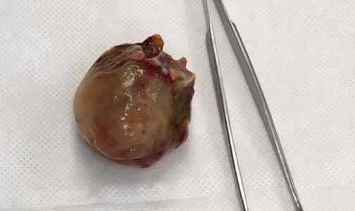 В Елизаветинской больнице впервые экстренно прооперировали пациента с опухолью на сердце