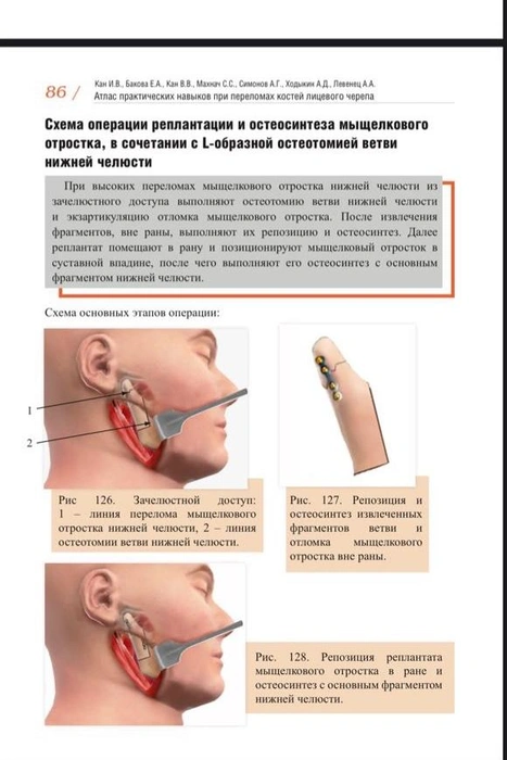 Операцию проводили по методике L-образной остеотомии ветви нижней челюсти и реплантации мыщелкового отростка | Источник: Краевая клиническая больница / vk.com