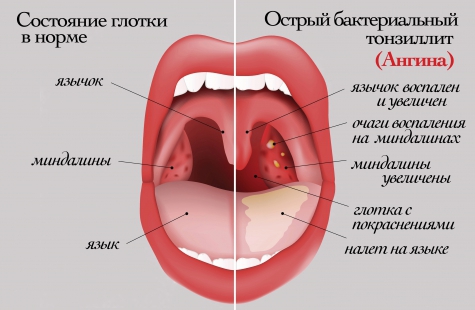 Ангина у детей