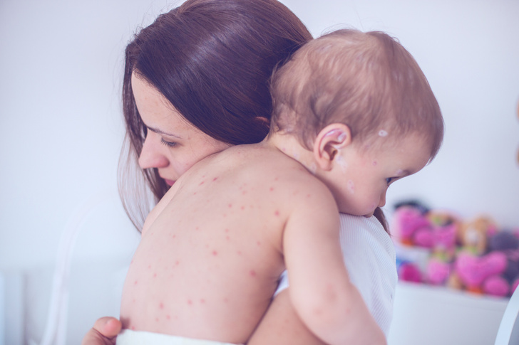 Фото №2 - Аллергия у детей до года: симптомы и профилактика