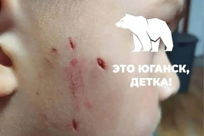 Собака покусала лицо ребенку в Нефтеюганске