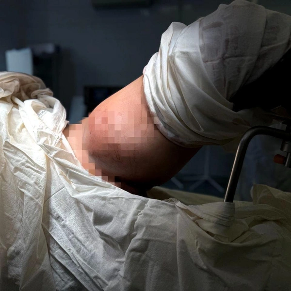 Сам пациент худой, поэтому у него в ноге отчетливо видно образование | Источник: Михаил Денисов