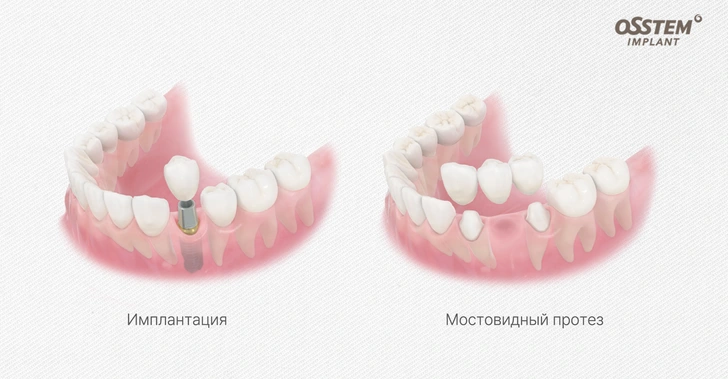 Восстанавливаем улыбку: имплантация или мост — как выбрать идеальное решение