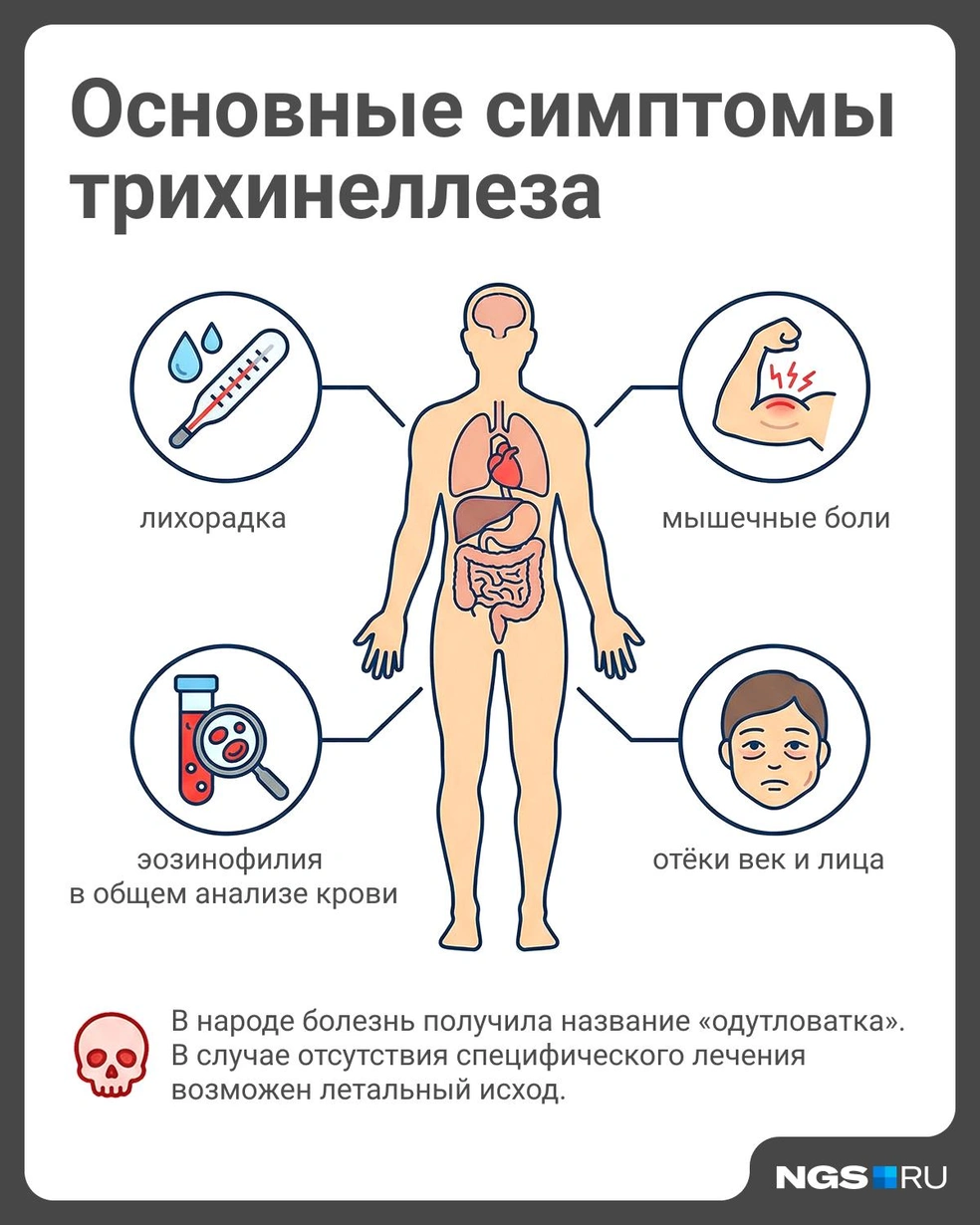 Трихинеллез может привести к проблемам с нервной системой | Источник: Юрий Орлов / Городские порталы