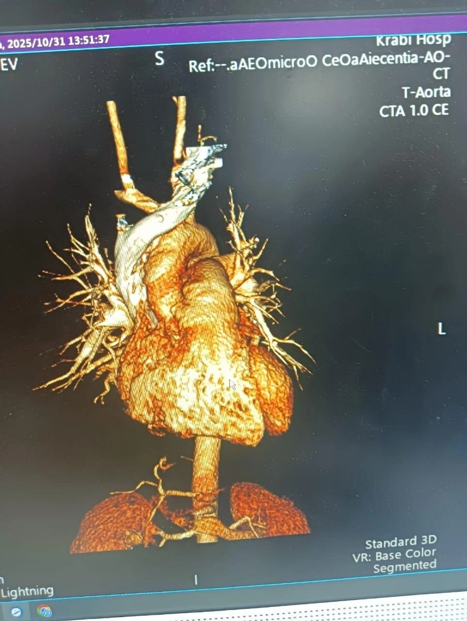 Из-за аневризмы Аркадия не могут транспортировать в Россию | Источник: Ксения Хомутова