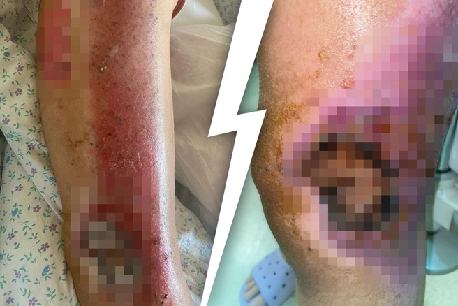 Ноги девочки. Ей пересадили кожу, которая на данный момент приживается  | Источник: Дмитрий Гладышев, Лариса Петрученя