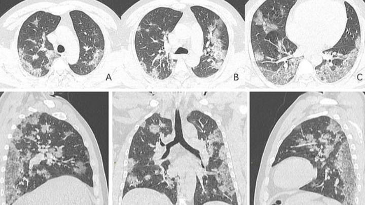 Как выглядят пораженные коронавирусом легкие на рентген-снимке