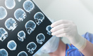 Университет Линчепинга: «У людей с постковидным синдромом изменилось строение мозга»