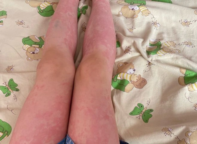 В Рязани у пятилетнего ребенка развился отек Квинке после прививки | ya62.ru