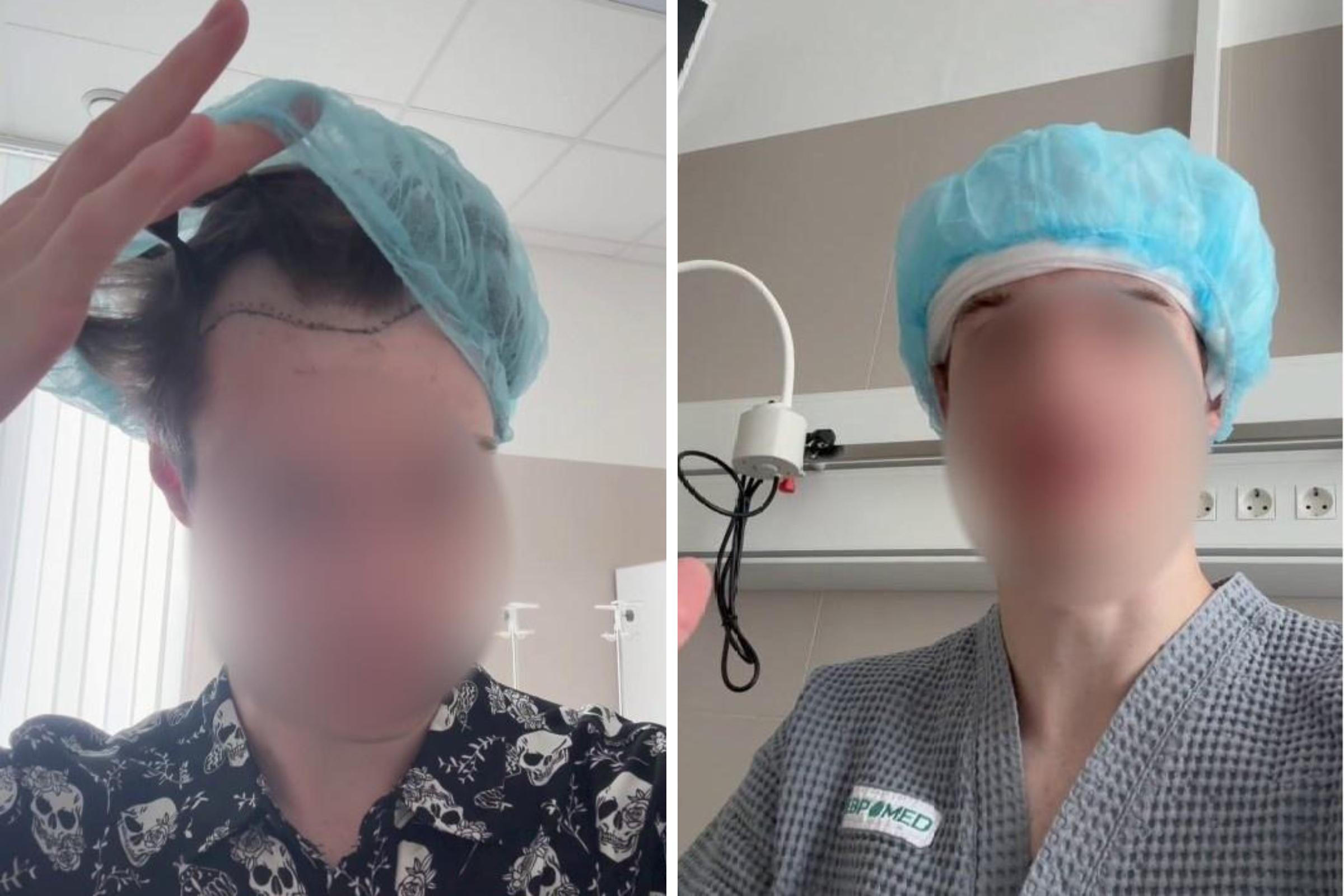 «Думал, голова взорвется»: 27-летний россиянин показал результат пересадки волос за 100 тысяч рублей