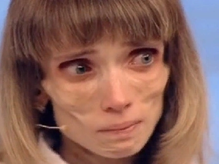 Похудевшая до 17 килограммов Кристина Корягина начала есть