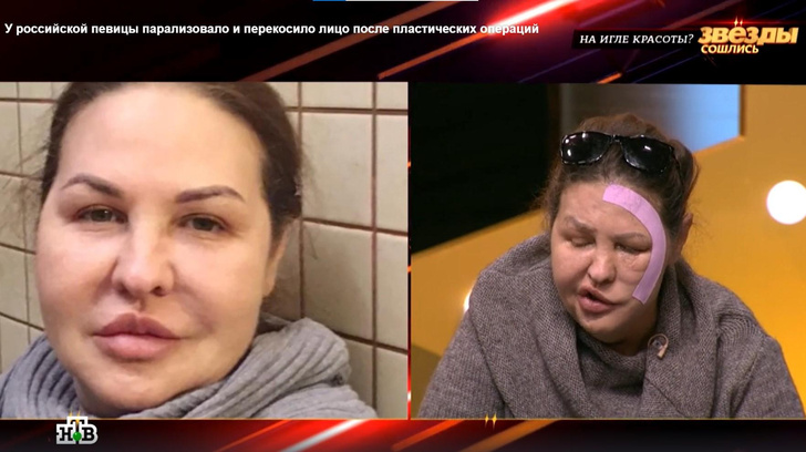 Пластический хирург изуродовал певицу Елену Демидову — она не спит и все время прячет лицо