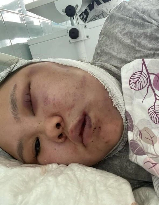 У Татьяны диагностировали перелом челюсти в двух местах | Источник: _tatishka_17_07 / instagram (экстремистская организация, деятельность запрещена в РФ)