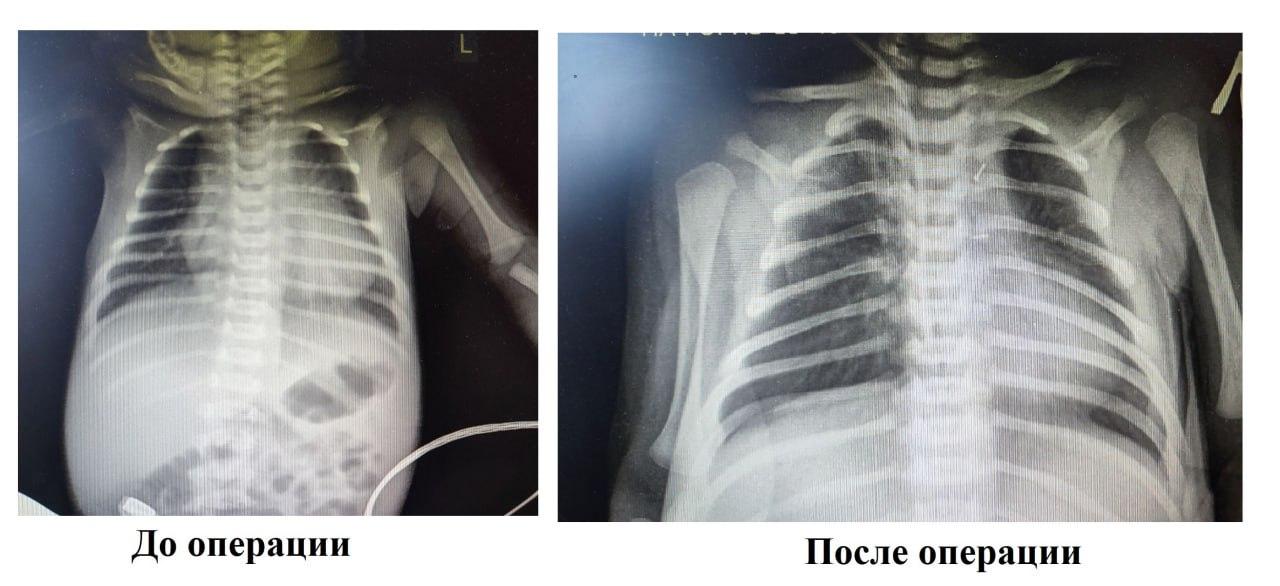 «Занимало большую часть грудной клетки»: врачи спасли новорожденного с редкой патологией сердца