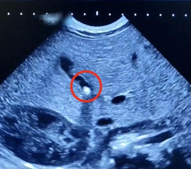 Врачей удивила «находка» на УЗИ | Источник: ГУЗ СО «Балаковская городская клиническая больница»