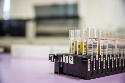 С-реактивный белок: о чём говорит его повышение в крови