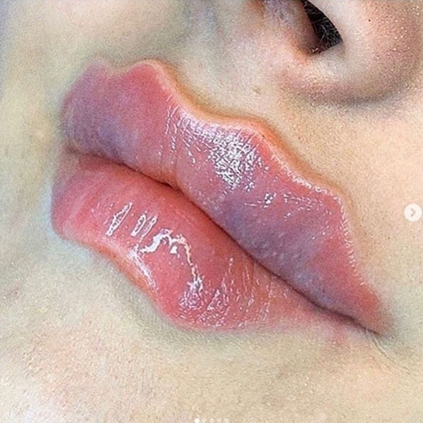 Фото №3 - Как «губы дьявола» стали самой обсуждаемой бьюти-методикой и почему косметологи не решаются о ней говорить