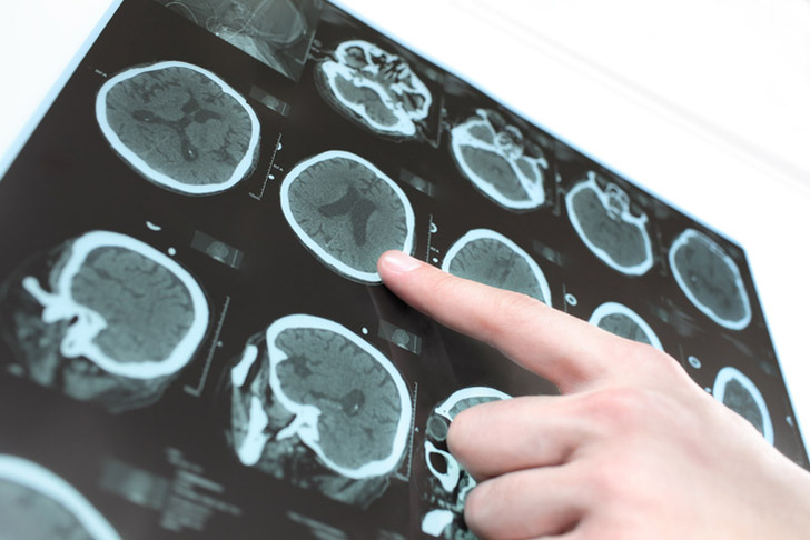 shutterstockСлово «нерв» восходит к латинскому nervus («ж´ила»). А родственная ему форма «невр» имеет греческое происхождение. По-гречески «нерв» или «ж´ила» – neuron.