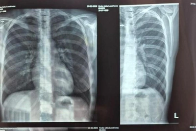 Гостья уральского отеля сломала ребро при падении на ступенях