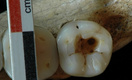 Ученые нашли зуб, вылеченный самым древним дантистом на Земле