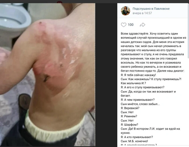 Автор публикации уверяет, якобы это спина того самого ошпаренного воспитателем малыша | Источник: Стоп-кадр со страницы «Подслушано в Павловске» / Vk.com