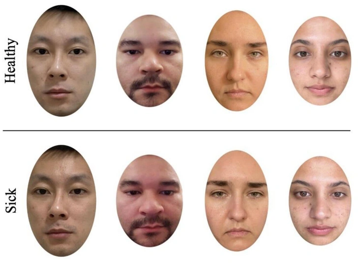 Диагноз по фотографии: женщины лучше вычислили больных по лицу Диагноз по фотографии: женщины лучше вычислили больных по лицу