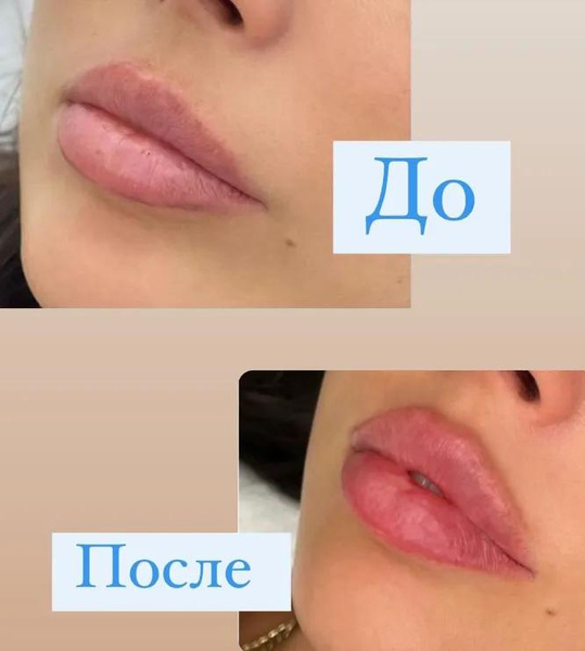 «Так мне нравится больше»: Оксана Самойлова показала губы до и после инъекций
