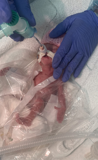 Девочка, родившаяся на 3 месяца раньше срока, была спасена с помощью целлофановых пакетов