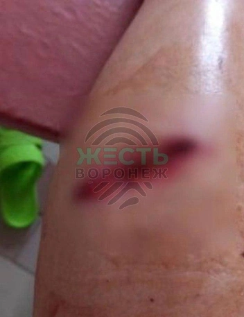 Пострадавшая женщина предстоит курс профилактических уколов против бешенства | Источник: vk.com/zhest_voronezh