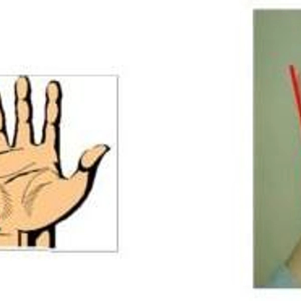 Синдром Прадера-Вилли фото | Источник: International Journal of Pediatric Endocrinology