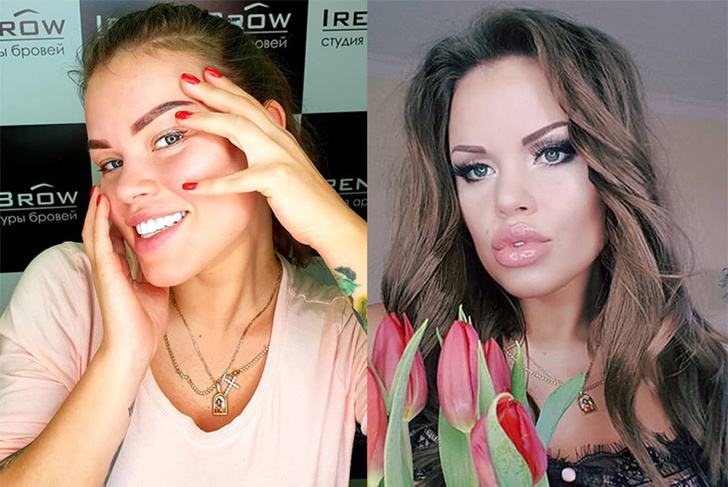 До и после: 15 девушек, которые зря накачали губы