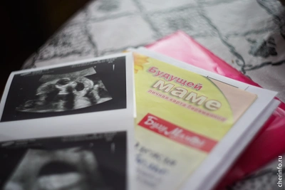 Аборты в Вологодской области сократились на 80%