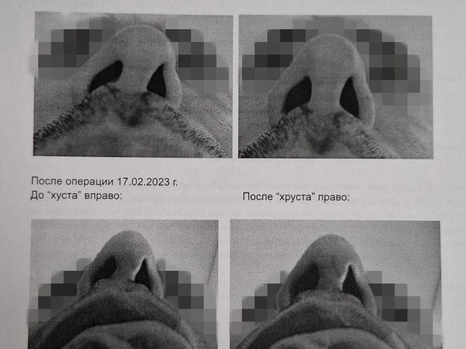 Как утверждает пациент, нос был деформирован и смещался при движении. | Источник: Тимофей Крылов, Юрий Скулыбердин / V1.RU