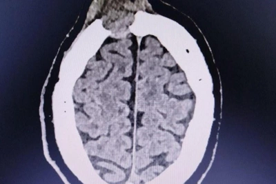 Surgeons Remove Tumor Eroding Man's Skull in Udmurtia