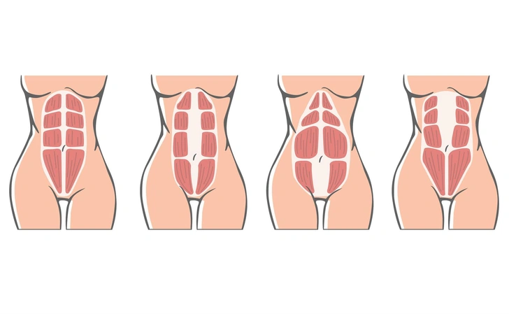 Почему упражнения не помогают убрать диастаз