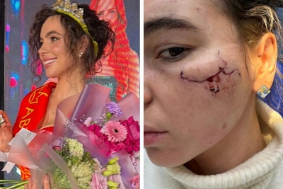 Девушка порезала лицо стаканом в казанском клубе