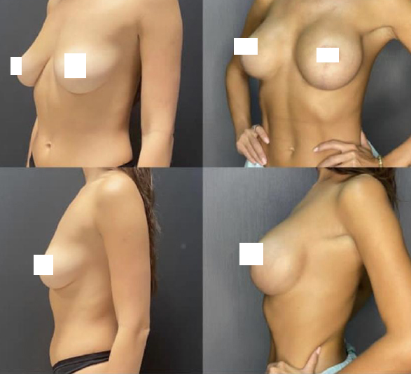 6 фото, которые вы должны увидеть, прежде чем решитесь на пластику груди
