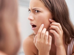 Как убрать жировики на лице: отвечают пользовательницы Woman.ru