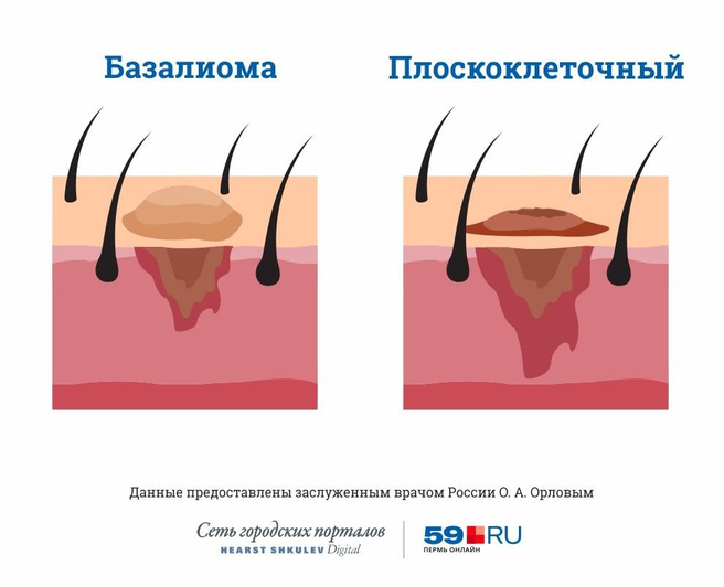 Виды Раков Кожи Фото