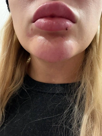 У девушки синяк на подбородке  | Источник: личный архив Киры