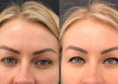Тотальное омоложение кожи: фото до и после лазерной шлифовки