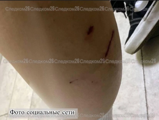 Собаки покусали подростка за ногу | Источник: СУ СКР по Ставропольскому краю