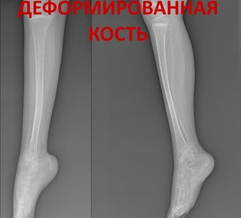 Так выглядит кость без штифта | Источник: Российская детская клиническая больница (РДКБ) / Vk.com 