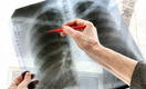 Петербургские врачи назвали мигрантов причиной роста заболеваемости детей туберкулезом