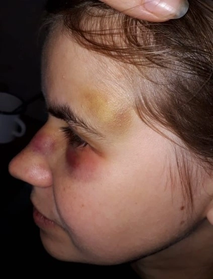 Избитая в октябре Любовь Покровская