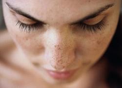 Все, что нужно знать о родинках