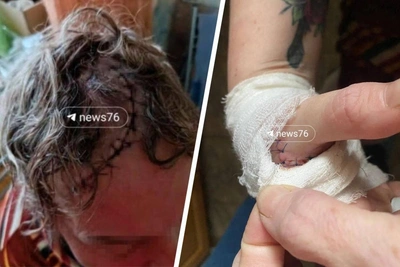 Yaroslavl pensioner displays injuries from store scissors assault